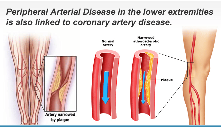 How Arterial Disease Affects Your Life