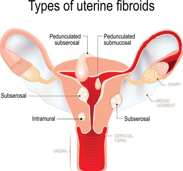 uterine fibroid embolization