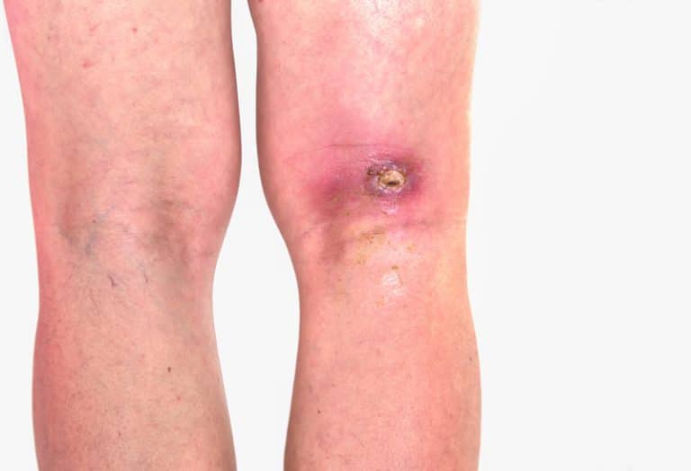 Venous Ulcers Leg Ulcers Arterial Disease Houston Tx 2375