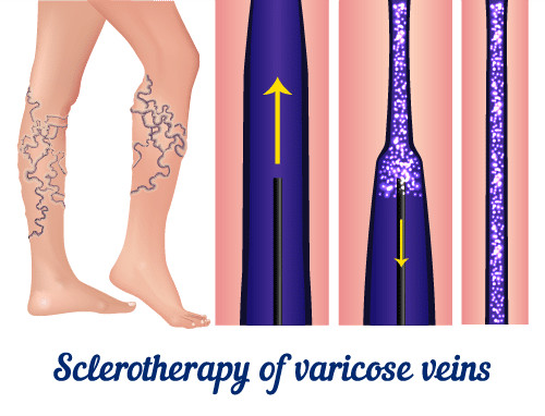 Sclerotherapy Treatment Of Varicose Veins