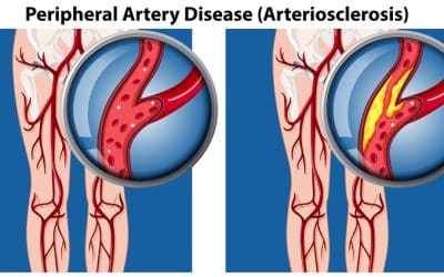 Complications From Peripheral Arterial Disease