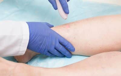 Reduce The Symptoms Of Varicose Veins With Laser Therapy