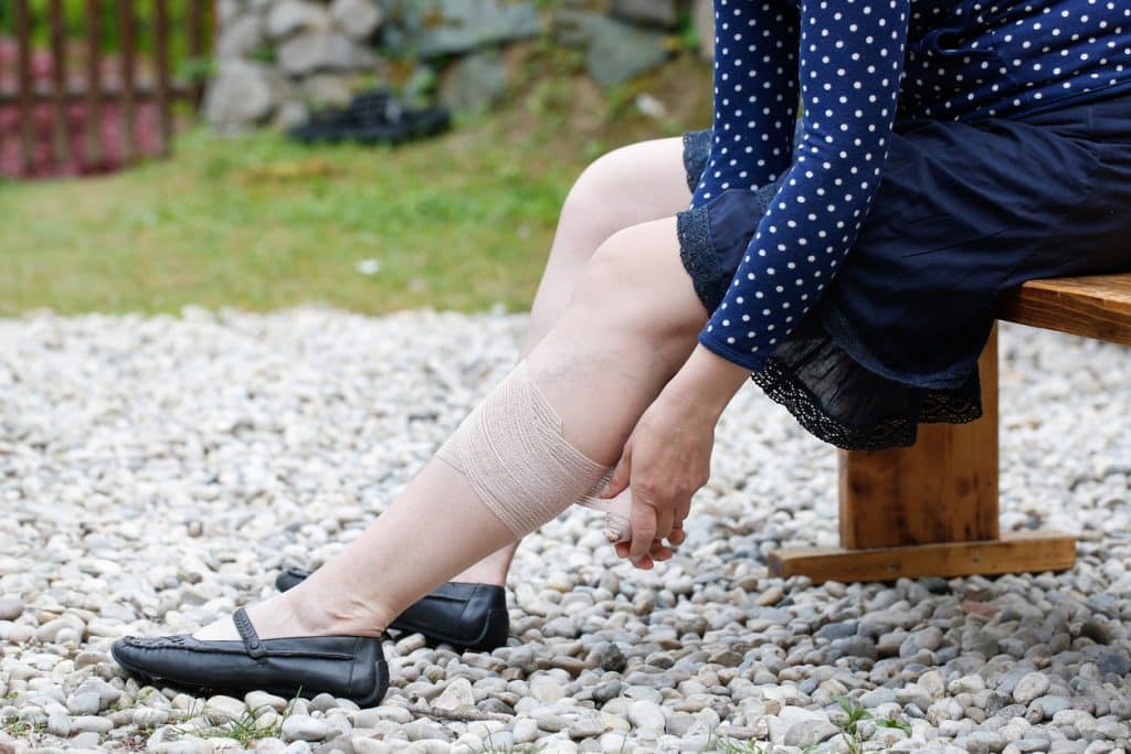 Woman with Leg Ulcers