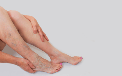 The Dangers Of Leaving Varicose Veins Untreated